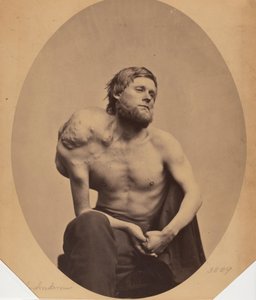 Enchondroma av scapula